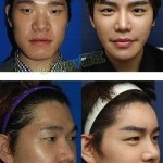 korean-boy-before-and-after-surgery-4.jpg