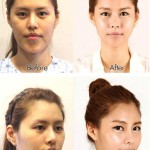 plastic-surgery-in-korea-4.jpg