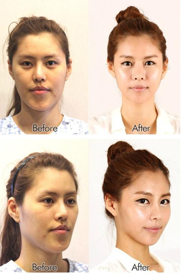 plastic-surgery-in-korea-4.jpg